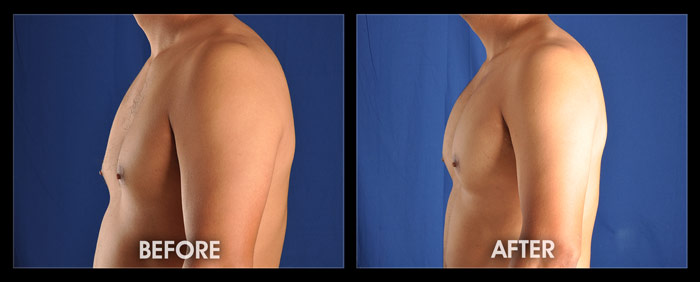 Plastic Surgery Case Study - Custom XL Pectoral Implants in the