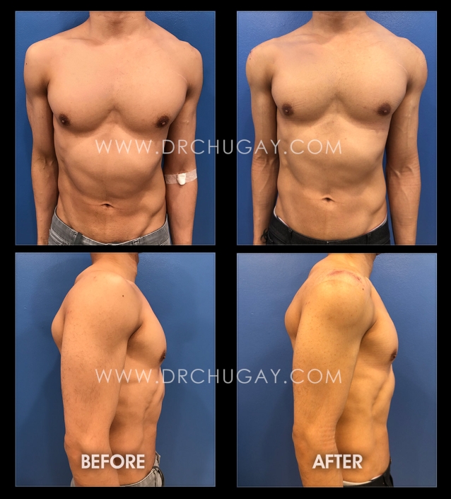 37yo male one week after size 1 deltoid augmentation (Note: asymmetry of shoulders due to scoliosis discussed with patient preop)