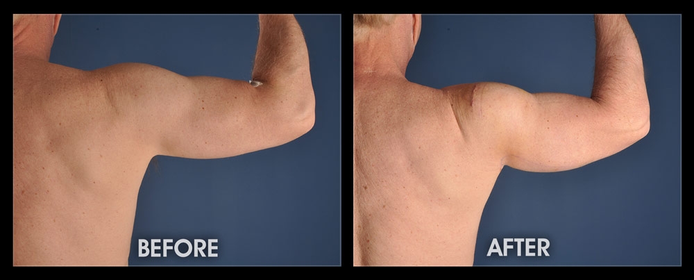 https://www.bestbodyimplants.com/wp-content/uploads/2019/07/before-after-bicept-tricep-implants.jpg