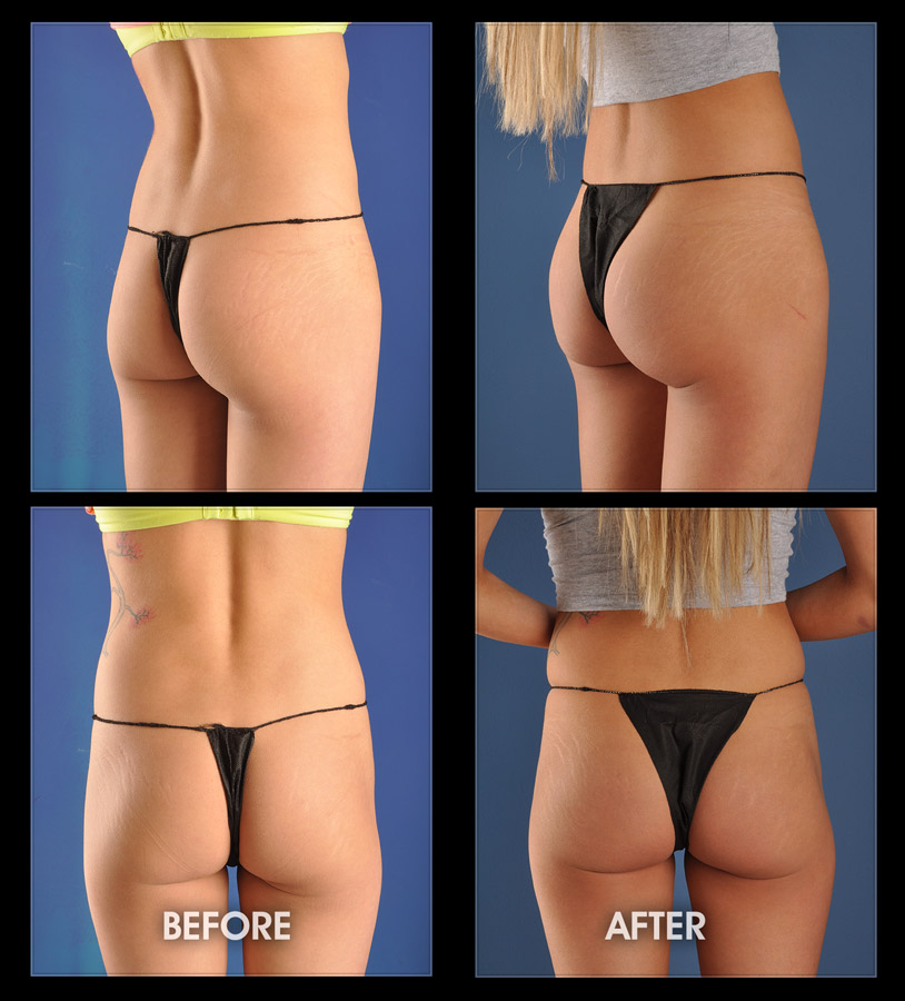 Brazilian Butt Lift Vs. Buttocks Implants