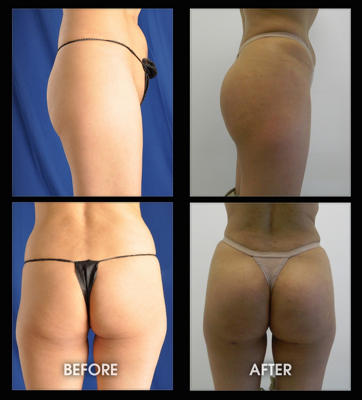 Buttock Implants - Before and After Image Gallery, Plastic Surgery
