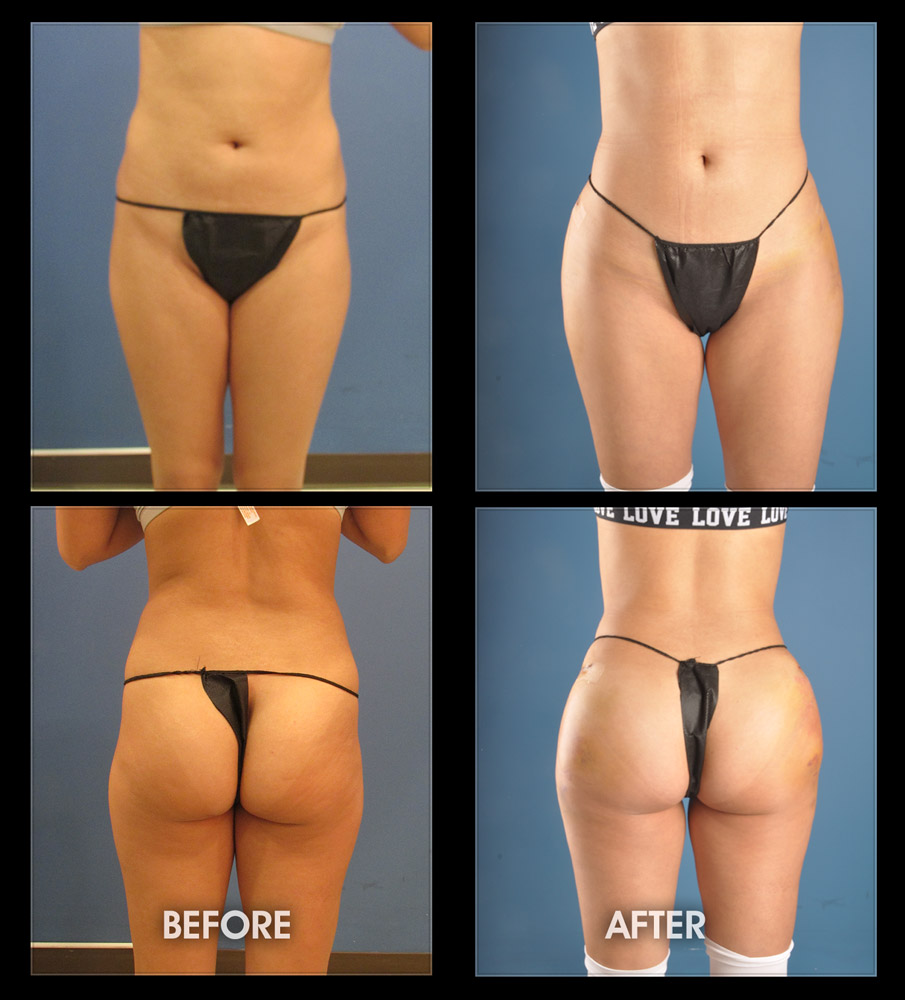 Hip Implants - Before and After Image Gallery, Plastic Surgery