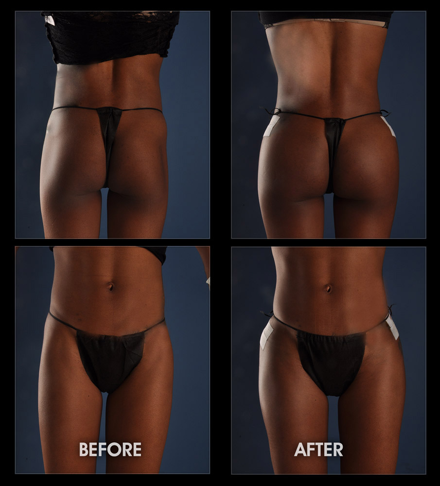 https://www.bestbodyimplants.com/wp-content/uploads/2019/12/hip-thigh-implants-before-after-03.jpg